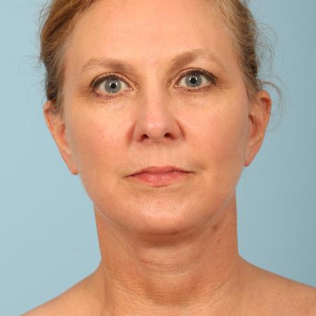 After image 1 Case #116591 - Facelift, Necklift, TCA Peel