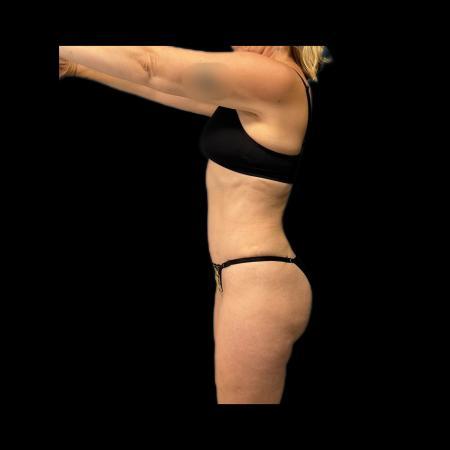 After image 3 Case #116076 - R.A.F.T LipoAbdominoplasty and LipoEsculture 