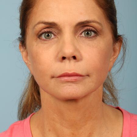 After image 1 Case #116586 - Facelift, Necklift