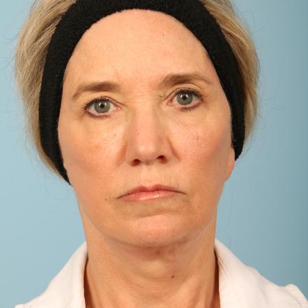 After image 1 Case #116606 - Facelift with Fat Transfer