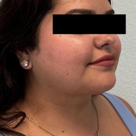 After image 2 Case #116096 - Submental neck liposuction