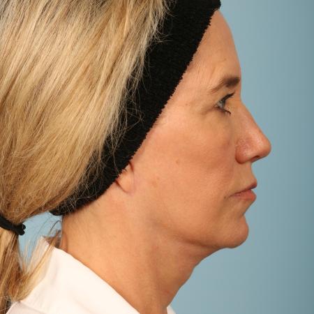 After image 3 Case #116606 - Facelift with Fat Transfer