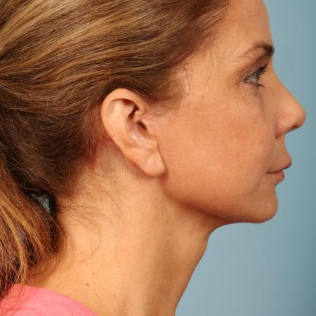 After image 3 Case #116586 - Facelift, Necklift