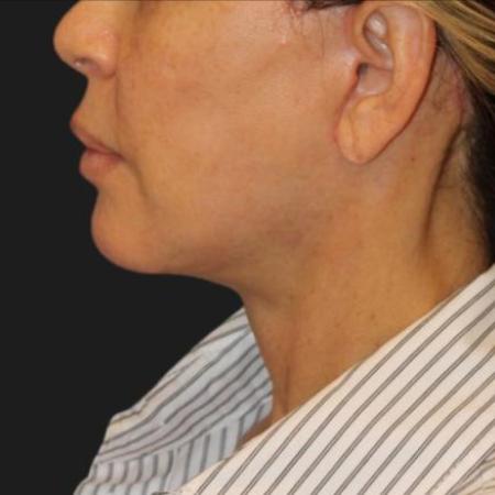 After image 4 Case #116241 - 55 year old patient | Facial Rejuvenation