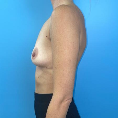 Before image 3 Case #116836 - Breast implants with internal lift