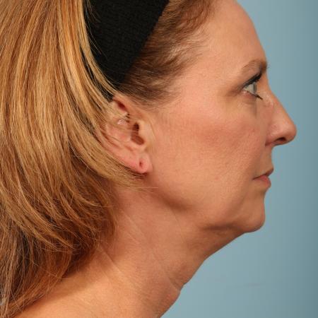 Before image 3 Case #116591 - Facelift, Necklift, TCA Peel