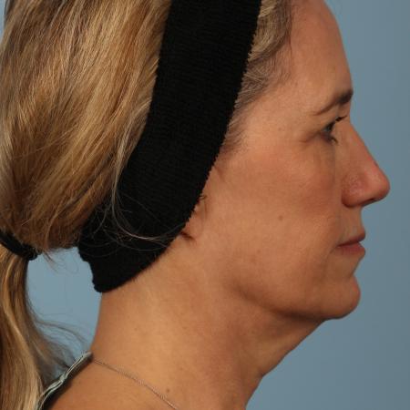 Before image 3 Case #116606 - Facelift with Fat Transfer