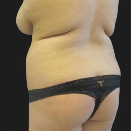 Before image 4 Case #116651 - 23 year-old patient | Liposuction