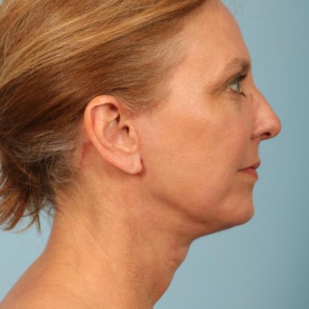 After image 3 Case #116591 - Facelift, Necklift, TCA Peel