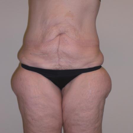 Before image 1 Case #116766 - Body Contouring after Weight Loss