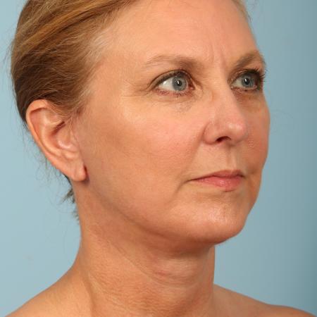 After image 2 Case #116591 - Facelift, Necklift, TCA Peel