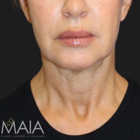 Before image 1 Case #116241 - 55 year old patient | Facial Rejuvenation