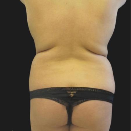 Before image 5 Case #116651 - 23 year-old patient | Liposuction