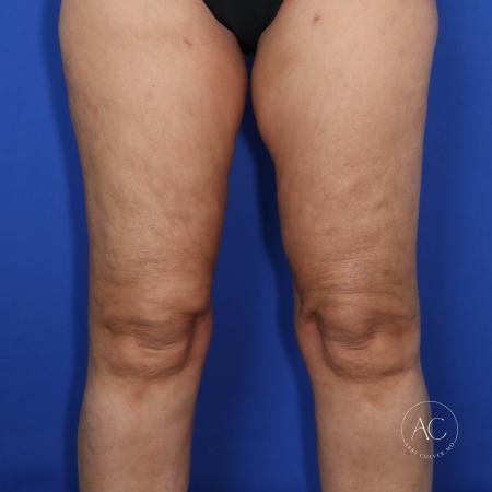 After image 1 Case #117281 - Circumferential Thigh Liposuction