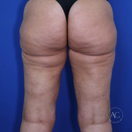 After image 4 Case #117281 - Circumferential Thigh Liposuction