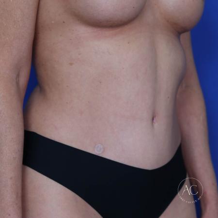 After image 4 Case #117286 - Abdominoplasty with Liposuction