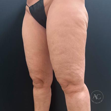 Before image 2 Case #117281 - Circumferential Thigh Liposuction