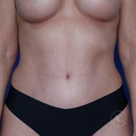 After image 1 Case #117286 - Abdominoplasty with Liposuction