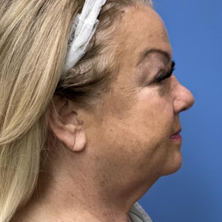 Before image 3 Case #117311 - 64 year old-Facelift/Blepharoplasty