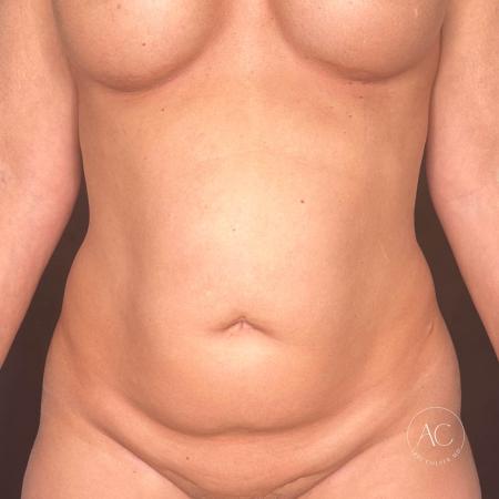 Before image 1 Case #117286 - Abdominoplasty with Liposuction