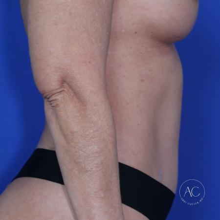After image 3 Case #117286 - Abdominoplasty with Liposuction After image 3 Case #117286 - Abdominoplasty with Liposuction