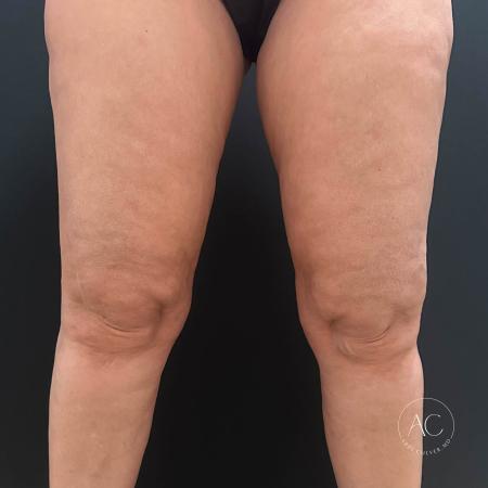 Before image 1 Case #117281 - Circumferential Thigh Liposuction