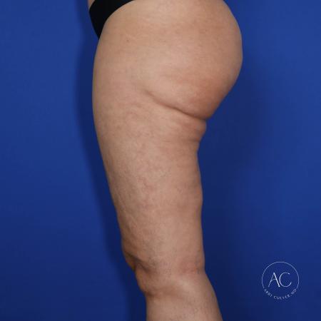 After image 3 Case #117281 - Circumferential Thigh Liposuction