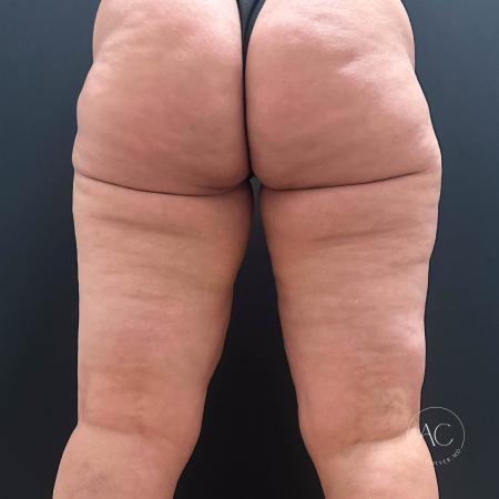 Before image 4 Case #117281 - Circumferential Thigh Liposuction