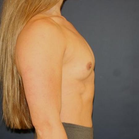 Before image 3 Case #117516 - Breast Augmentation