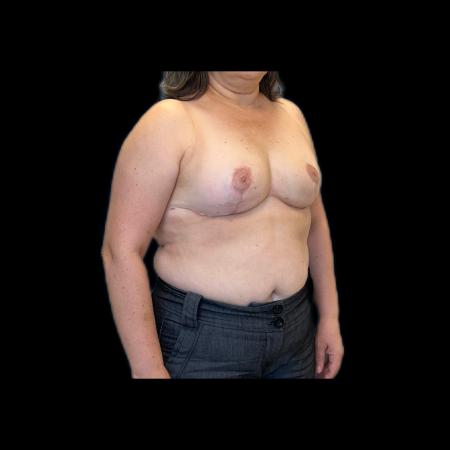 After image 2 Case #118126 - Breast Lift without Implants 