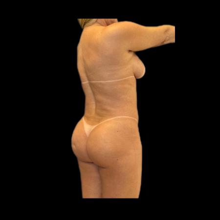 Before Case #118236 - LipoEsculture and Gluteal Fat Grafting 