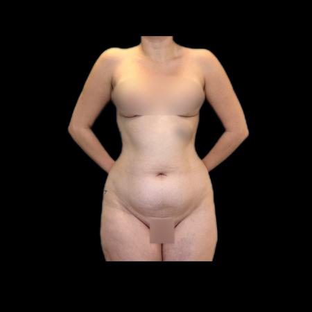 Before image 1 Case #118146 - R.A.F.T LipoAbdominoplasty