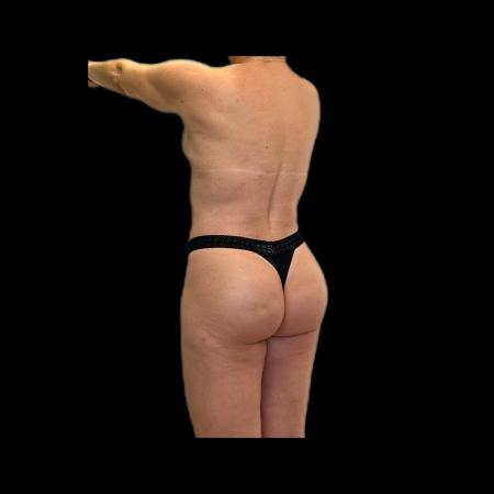 After Case #118236 - LipoEsculture and Gluteal Fat Grafting 