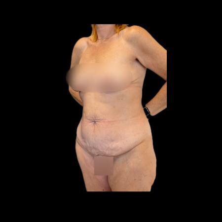 Before image 4 Case #118136 - Pos-Bariatric