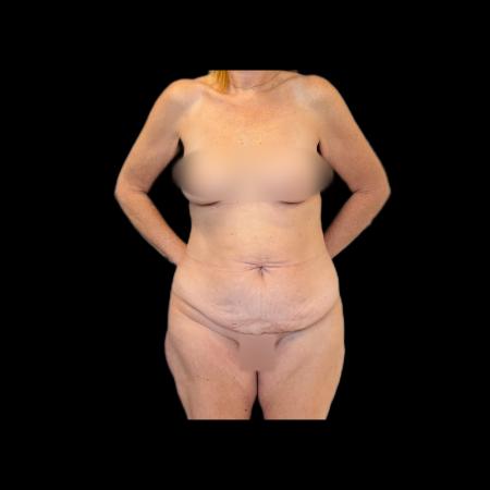 Before image 1 Case #118136 - Pos-Bariatric