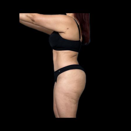 After image 5 Case #118131 - R.A.F.T LipoAbdominoplasty