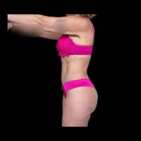 After image 3 Case #116076 - R.A.F.T LipoAbdominoplasty and LipoEsculture 