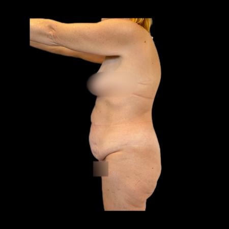 Before image 5 Case #118136 - Pos-Bariatric