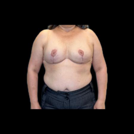 After image 6 Case #118126 - Breast Lift without Implants 