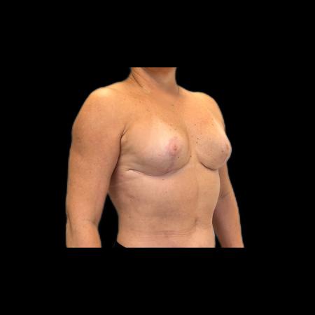 After image 2 Case #118141 - Mastopexy without Implants 