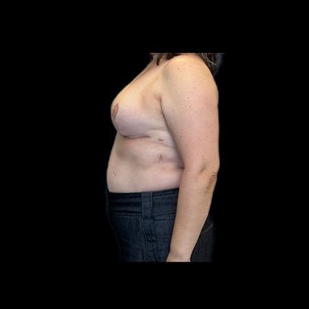 After image 5 Case #118126 - Breast Lift without Implants 