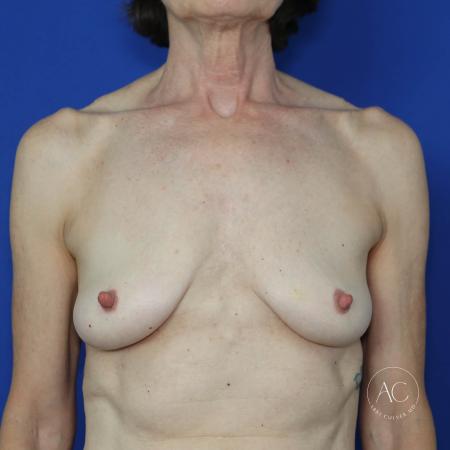 After image 1 Case #118936 - Breast Implant Removal