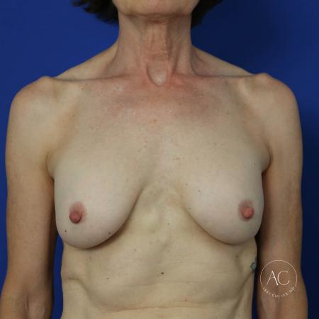 Before image 1 Case #118936 - Breast Implant Removal