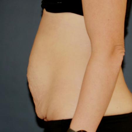 Before image 3 Case #119241 - Tummy Tuck (Abdominoplasty)