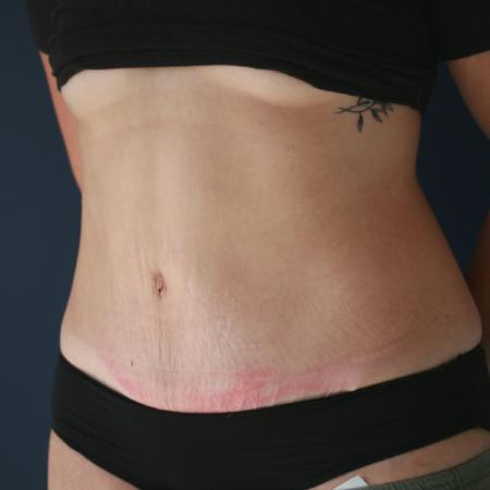 After image 2 Case #119241 - Tummy Tuck (Abdominoplasty)