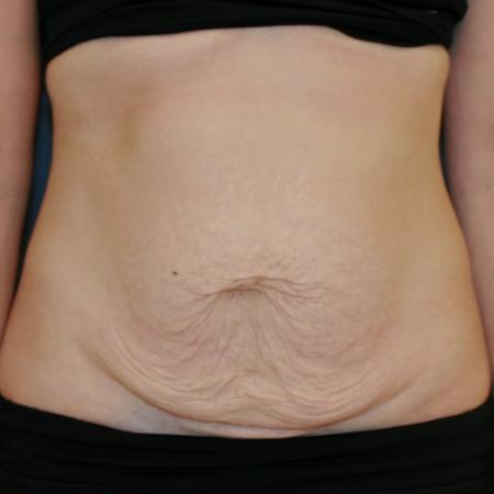 Before image 1 Case #119241 - Tummy Tuck (Abdominoplasty)