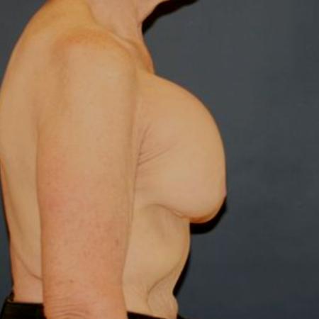 Before image 3 Case #121931 - Breast Revision