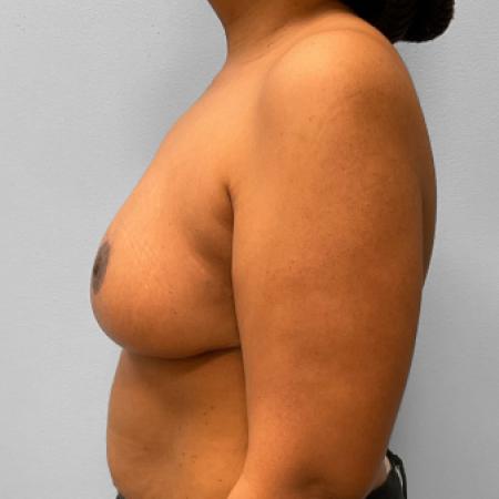 After image 3 Case #120916 - Breast Reduction