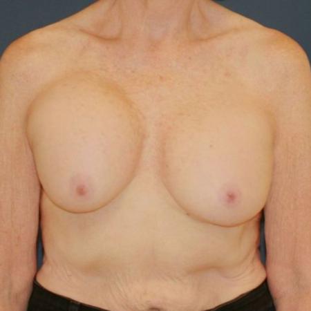 Before image 1 Case #121931 - Breast Revision