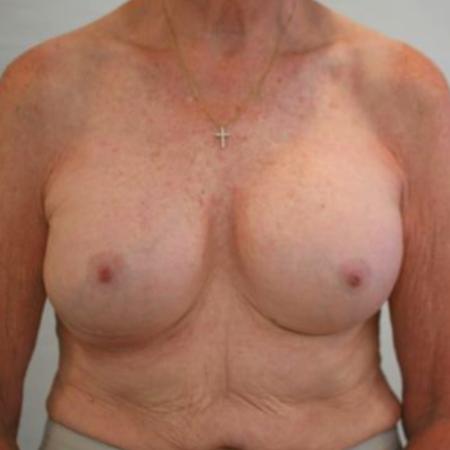 After image 1 Case #121931 - Breast Revision